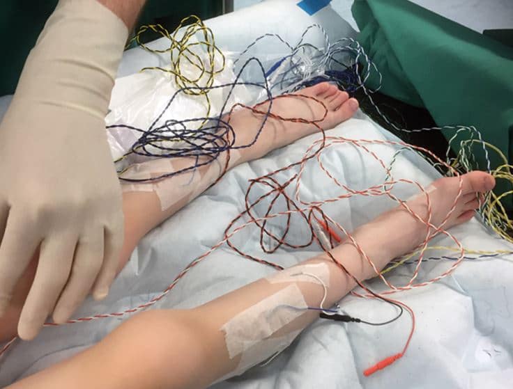 Spasticité : pour un meilleur développement de l’enfant • CHU Média